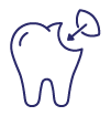 Dental Fillings